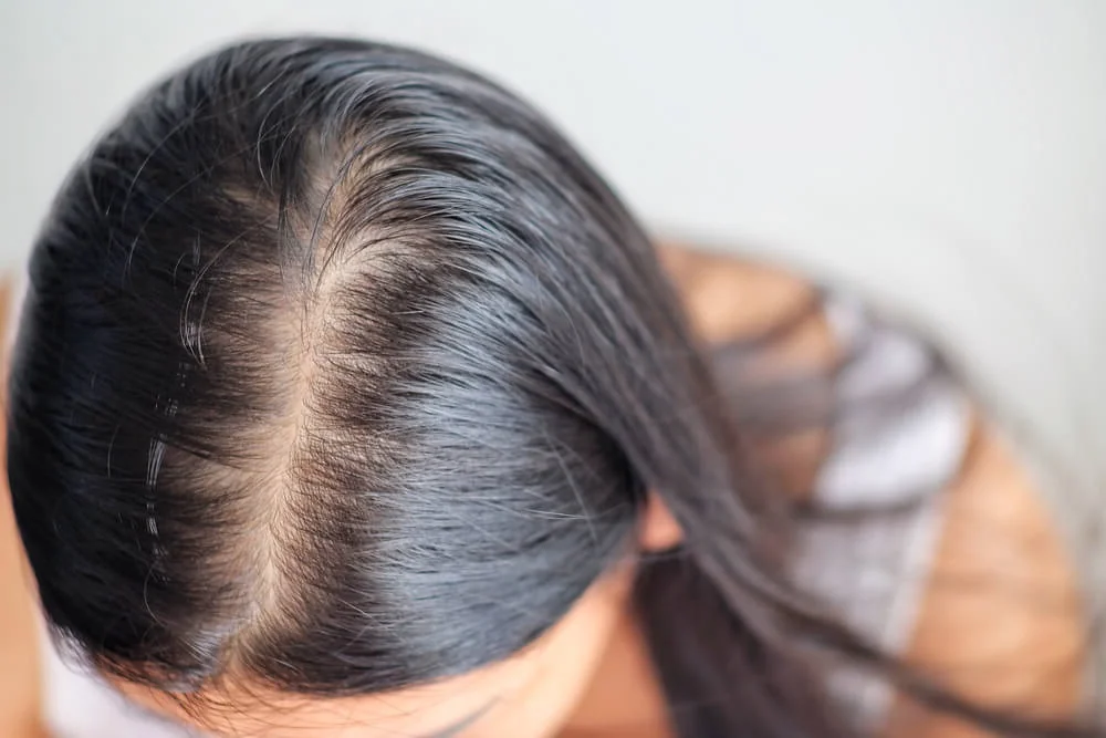 Nejčastější příčinou vypadávání vlasů je androgenní alopecie. Nejčastější příčinou vypadávání vlasů je androgenní alopecie.