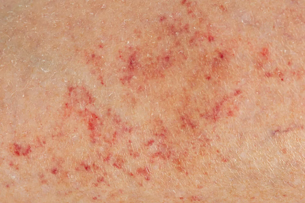 Na meningitidu může upozornit také petechiální vyrážka v podobě velkého počtu malých červených či fialových skvrnek.