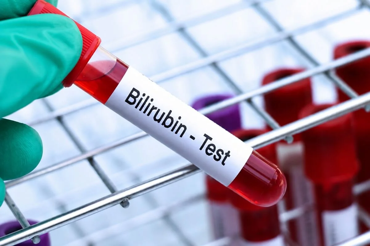Bilirubin – hodnoty, funkce a příznaky