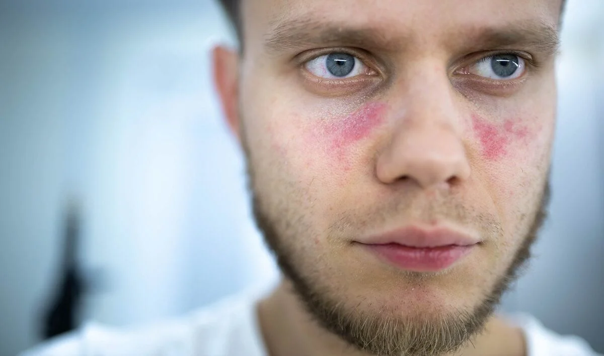 Lupus – příznaky, diagnostika a léčba