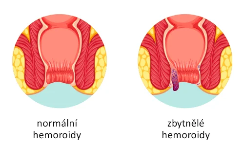 normální vs zbytnělé hemoroidy