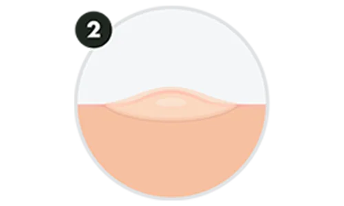 Zalepte pupínek. Nechte působit 6–8 hodin.