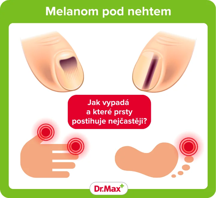 melanom pod nehtem melanom pod nehtem