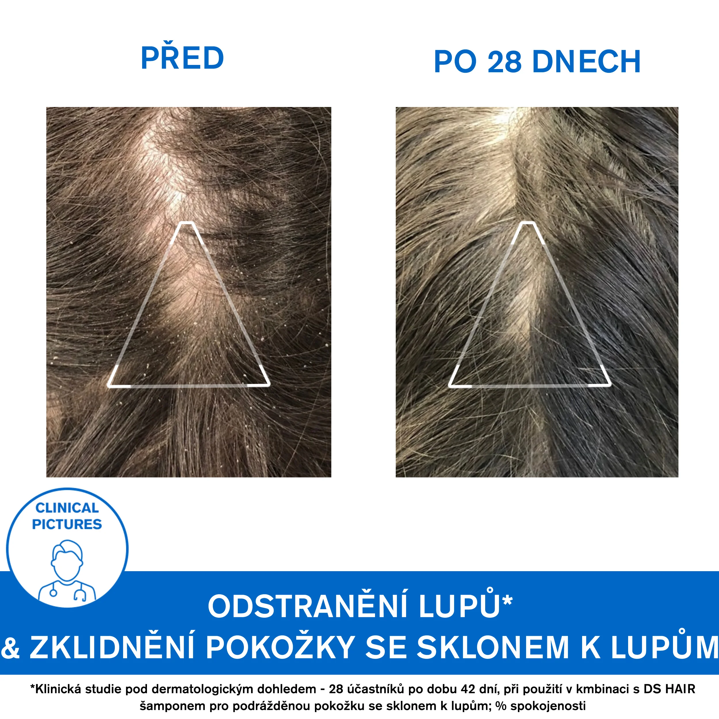 Uriage DS Hair Anti-Dandruff šampon proti lupům 200 ml