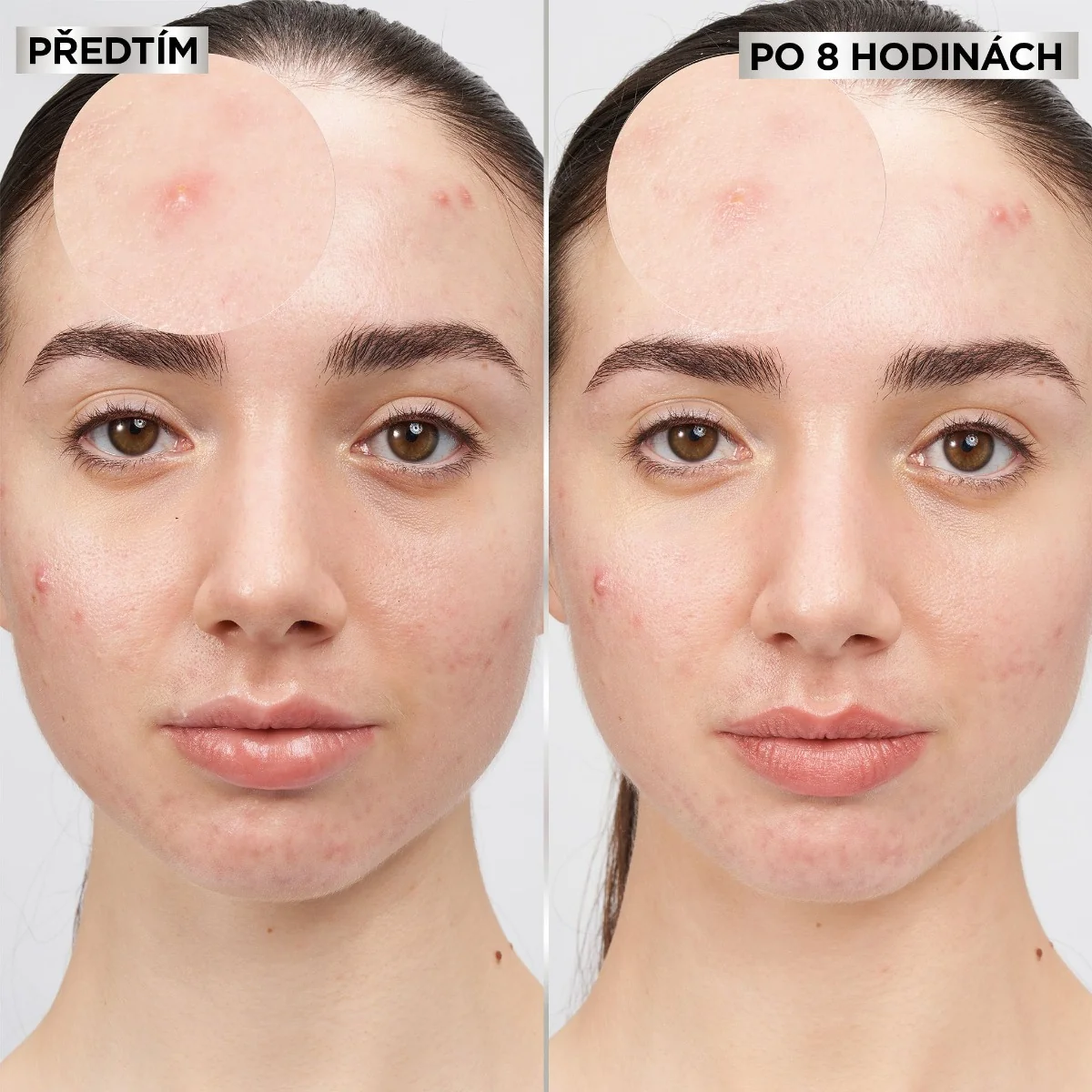 Garnier Pure Active hydrokoloidní náplasti na nedokonalosti 22 ks