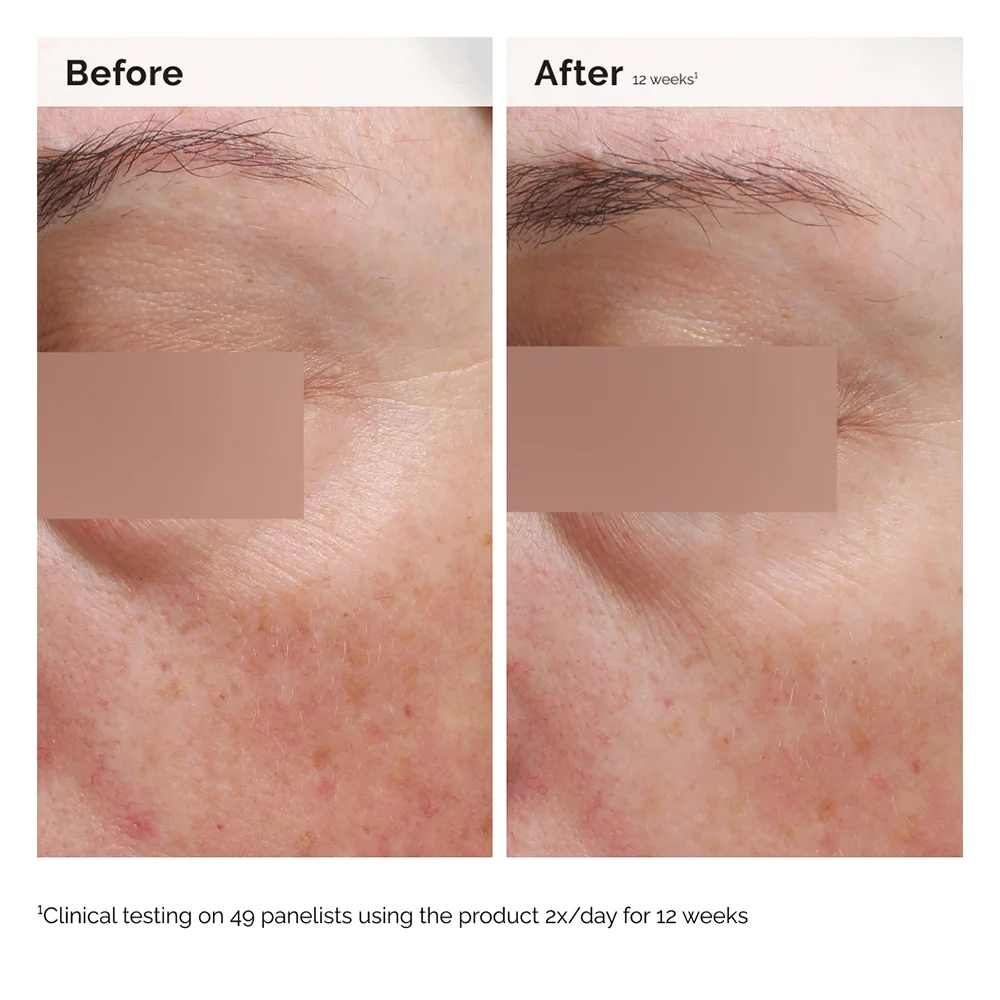 The Ordinary Niacinamide 5% Face & Body Emulsion hydratační emulze proti tmavým skvrnám 100 ml