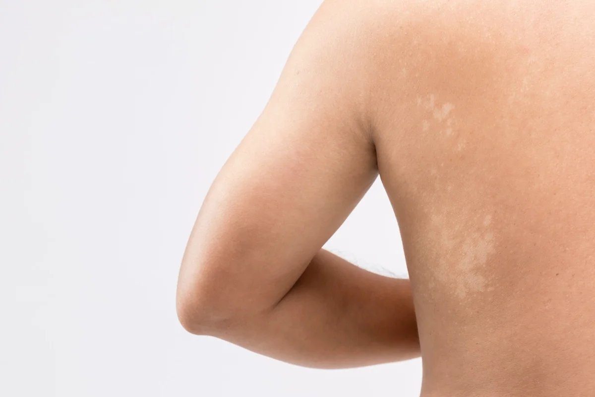 Pityriasis versicolor – jak ji poznat, proč vzniká a jak se léčí