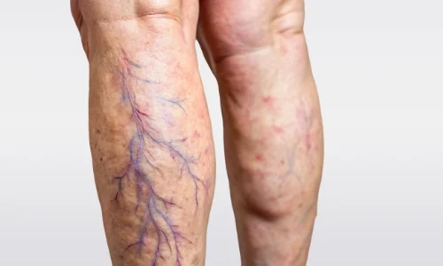 Na doporučení lékaře můžete Lioton® gel použít při léčbě Na doporučení lékaře můžete Lioton® gel použít při léčbě