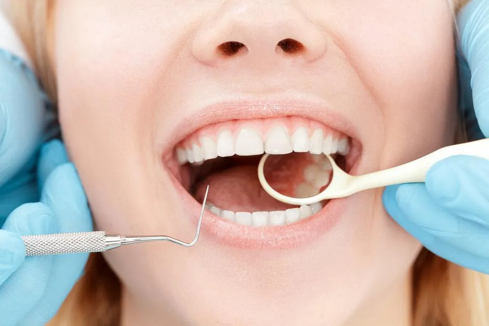 Zubní kámen – proč vzniká a jak ho odstranit?