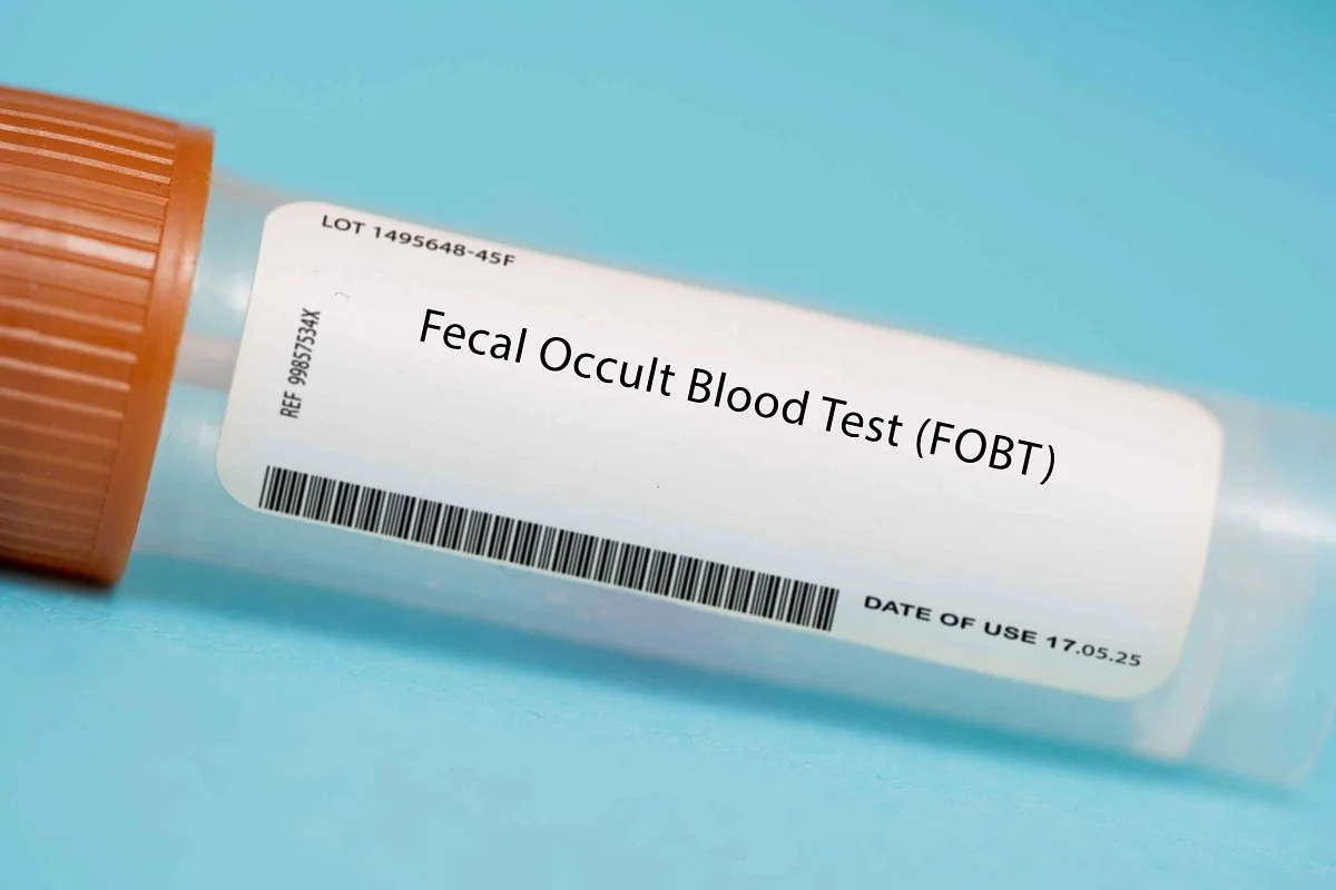 Test okultního krvácení znamená v praxi odběr vzorku stolice. Test okultního krvácení znamená v praxi odběr vzorku stolice.