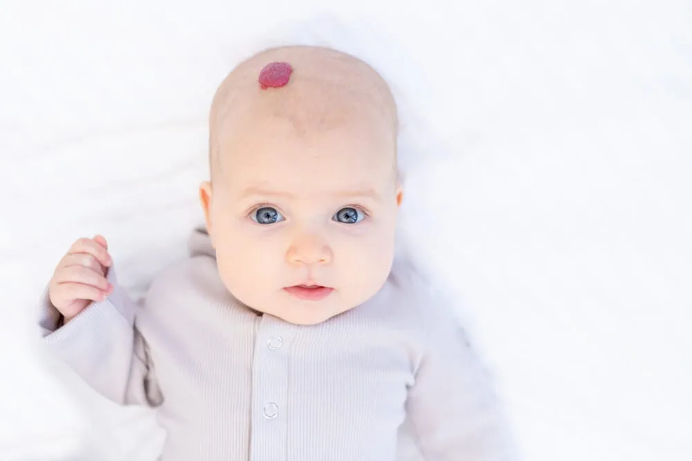 Infantilní hemangiom je jeden z nejčastějších nádorů dětského věku.