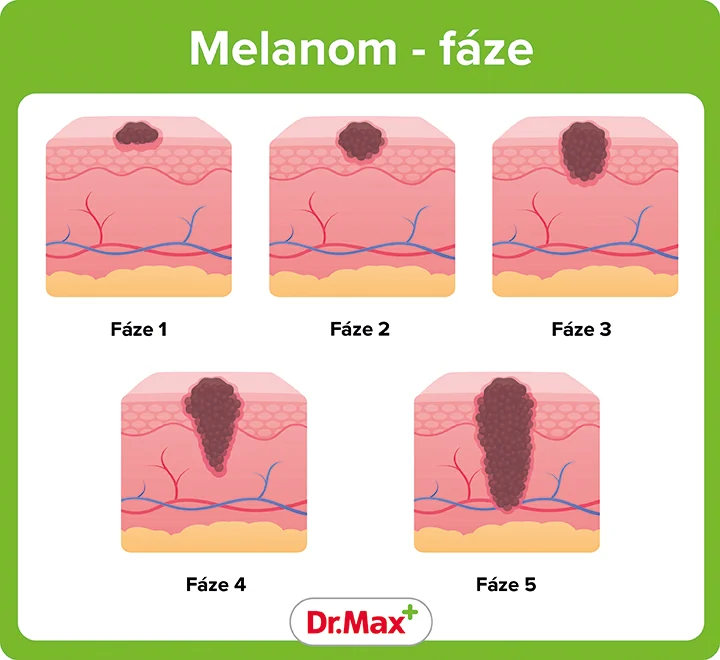 stádia melanomu stádia melanomu