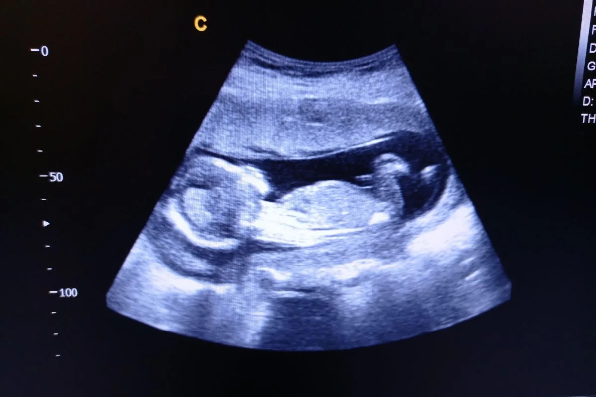Ultrazvuk v 18. TT Ultrazvuk v 18. TT