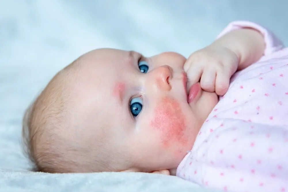 Atopický ekzém neboli atopická dermatitida je nepříjemné zánětlivé onemocnění kůže, které postihuje 15-30 % dětí.