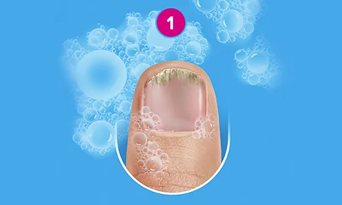 Jak přípravek Excilor® Forte aplikovat? Krok 1 Jak přípravek Excilor® Forte aplikovat? Krok 1