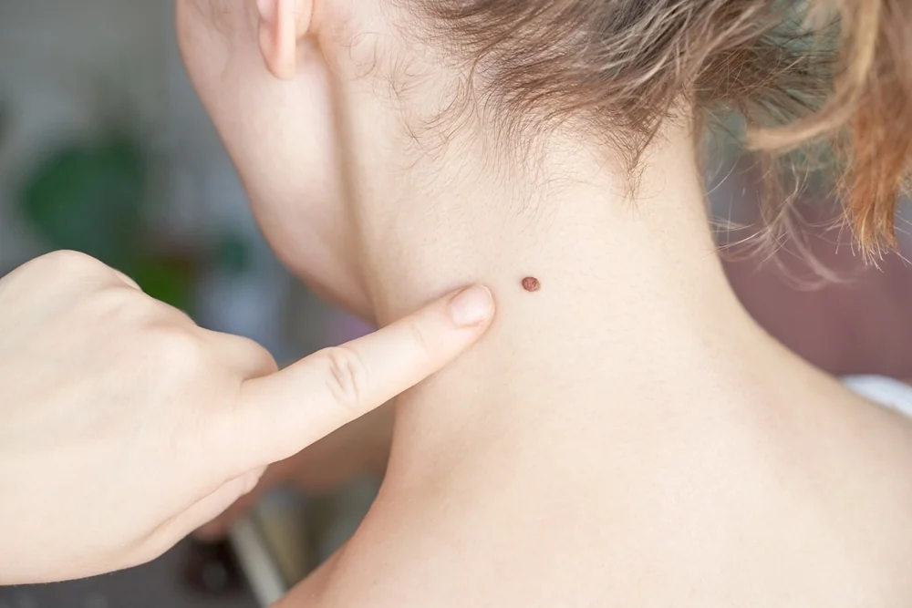 Fibrom – příčiny, příznaky a možnosti léčby