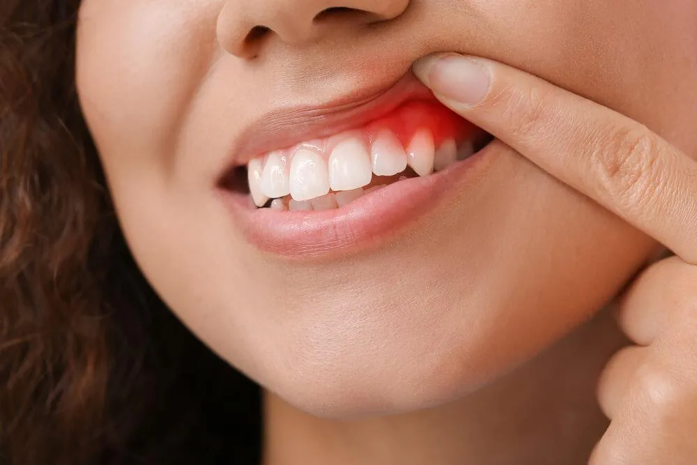 Zánět dásní – prevence a léčba