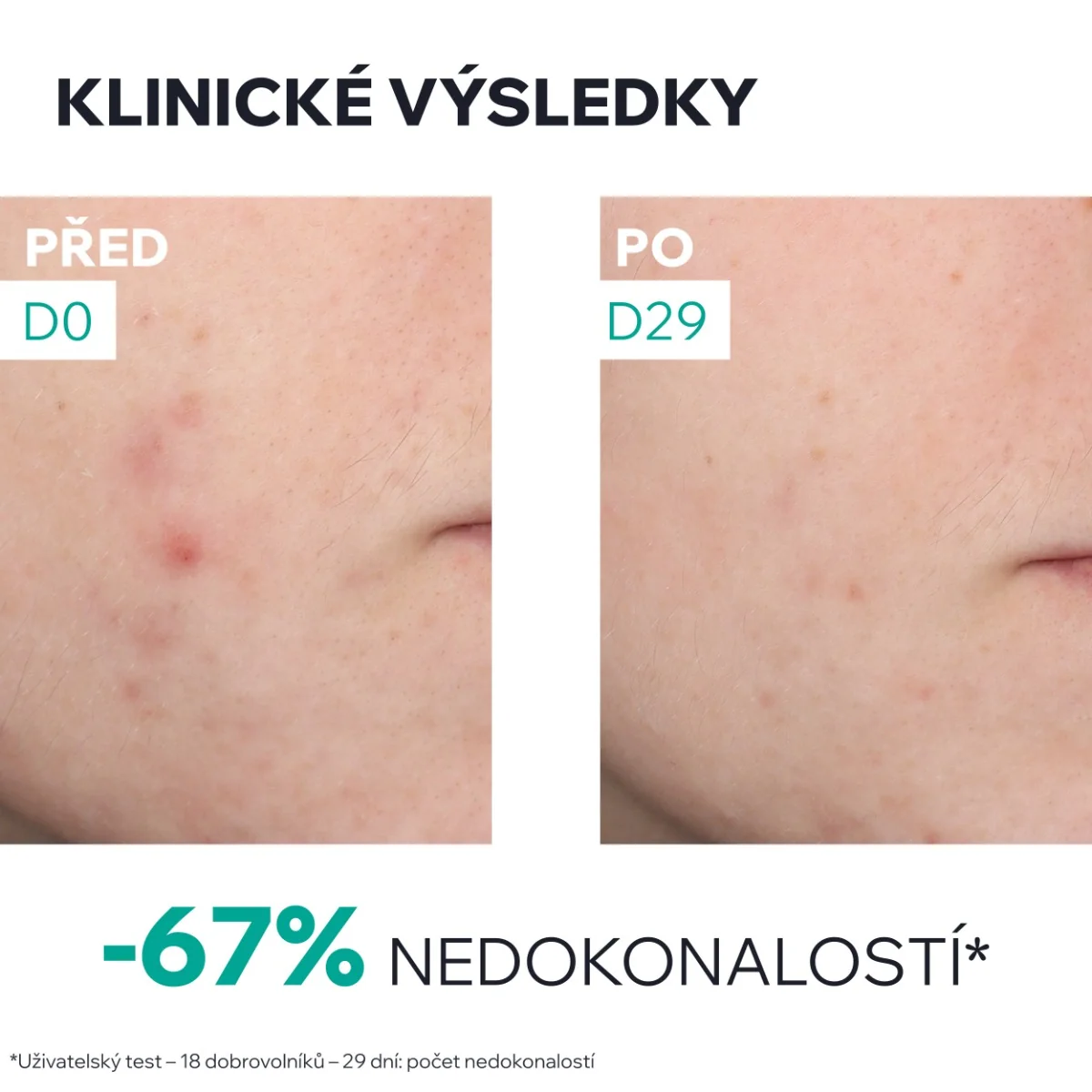 Uriage Hyséac Obnovující sérum proti nedokonalostem 30 ml