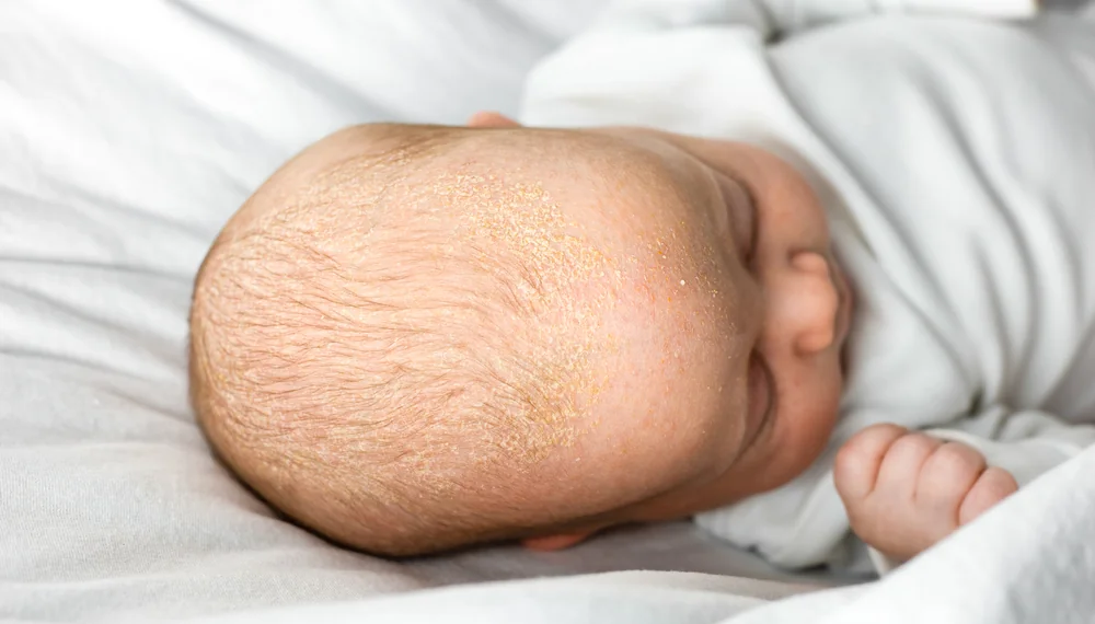 Seboroická dermatitida u miminek