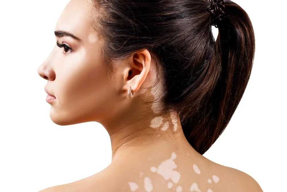 Vitiligo – příčina a léčba