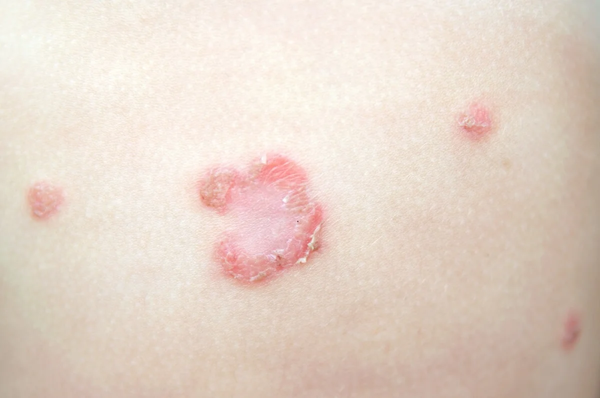 Impetigo nevyléčíte po domácku, nutná je návštěva lékaře a speciální antibiotická mast.