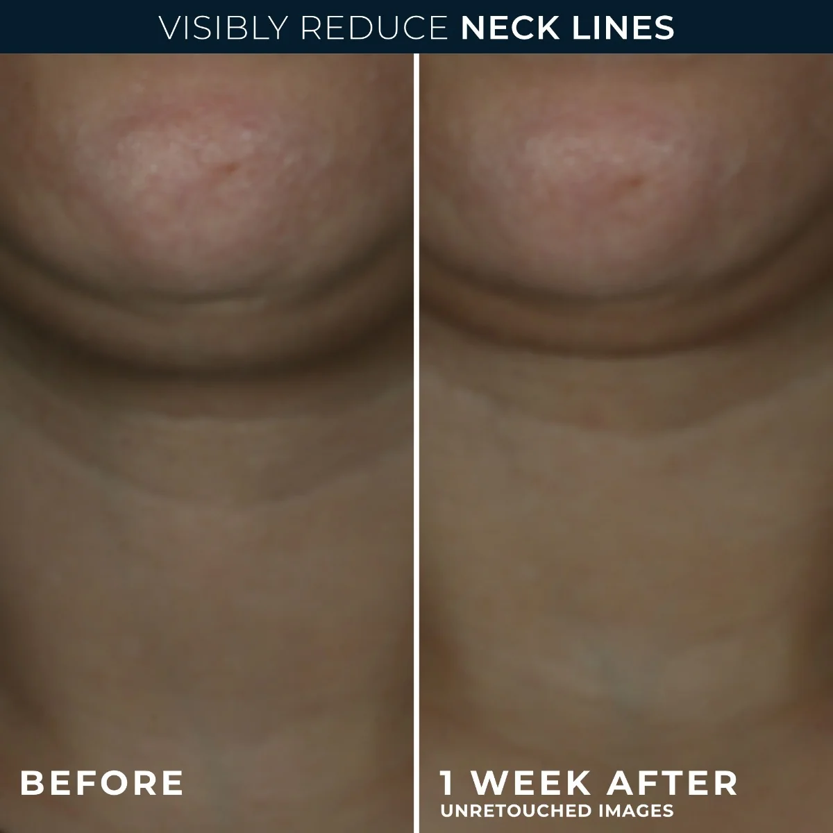 RoC Derm Correxion konturovací krém 50 ml