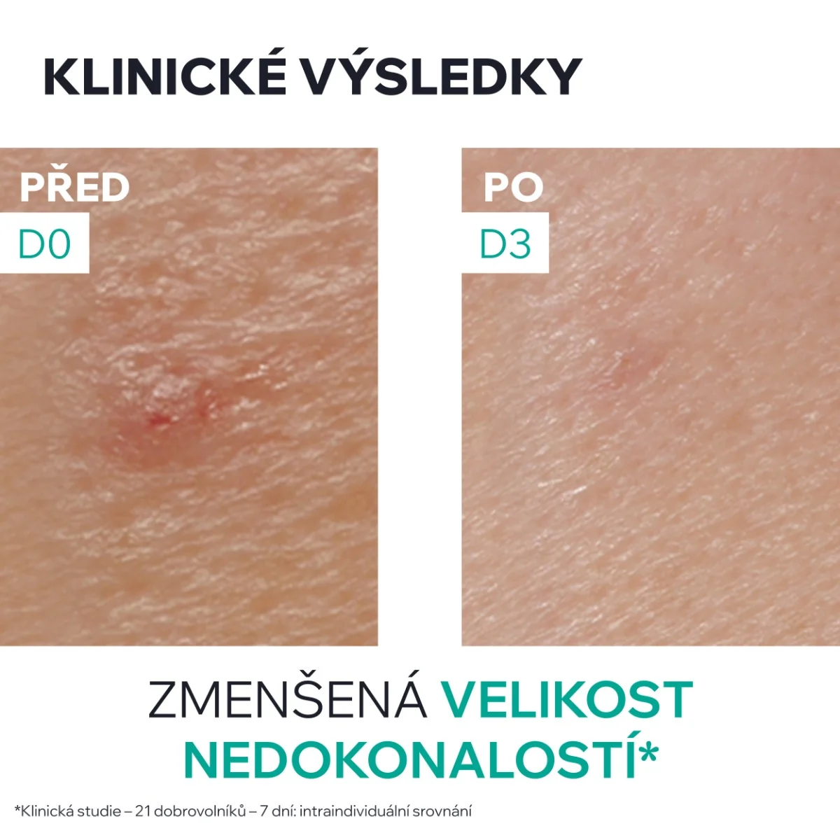 Uriage Hyséac SOS Pasta Lokální péče na nedokonalosti 15 g