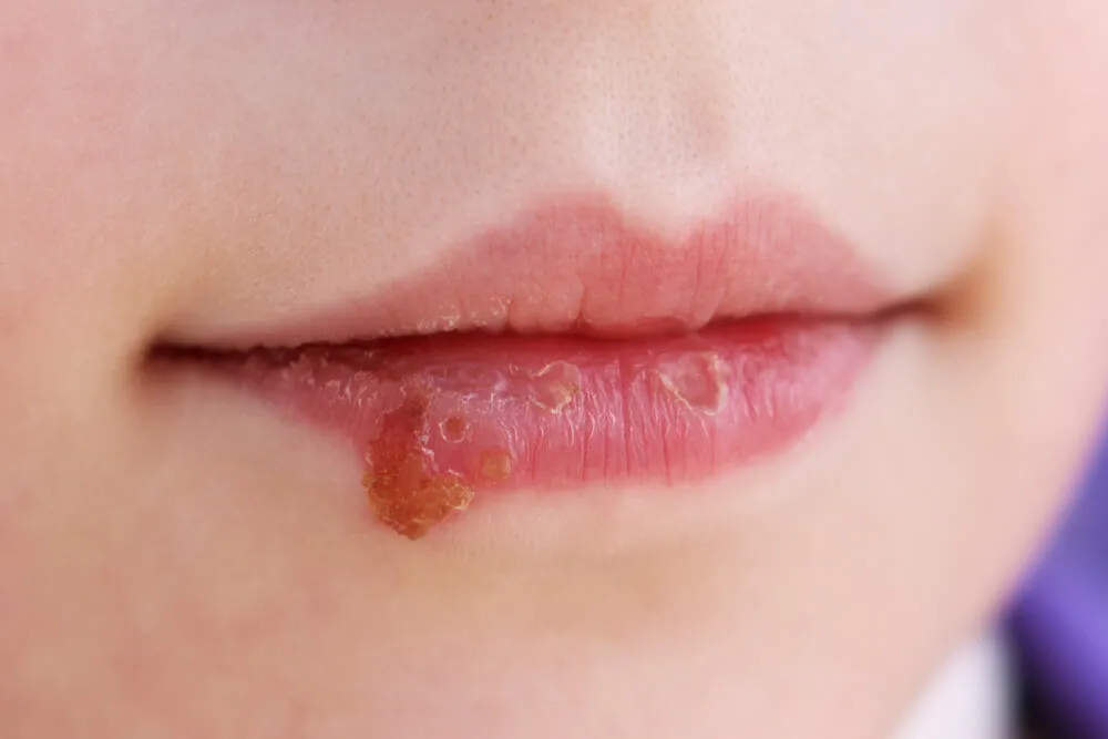 Impetigo je infekční zánětlivé onemocnění, které zpravidla postihuje malé děti v obličeji či na končetinách.