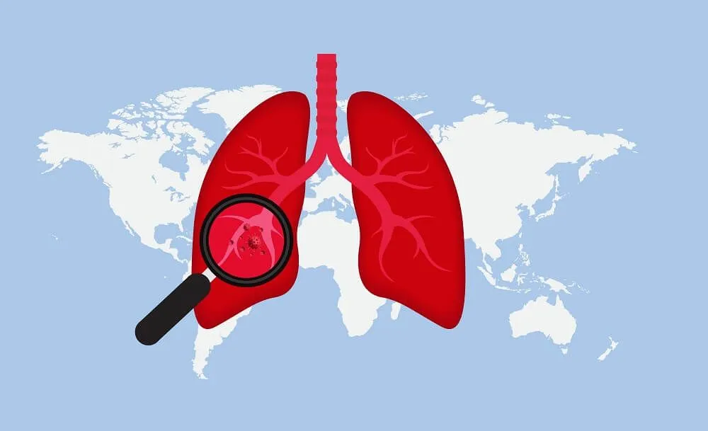 Tuberkulóza – příznaky a léčba