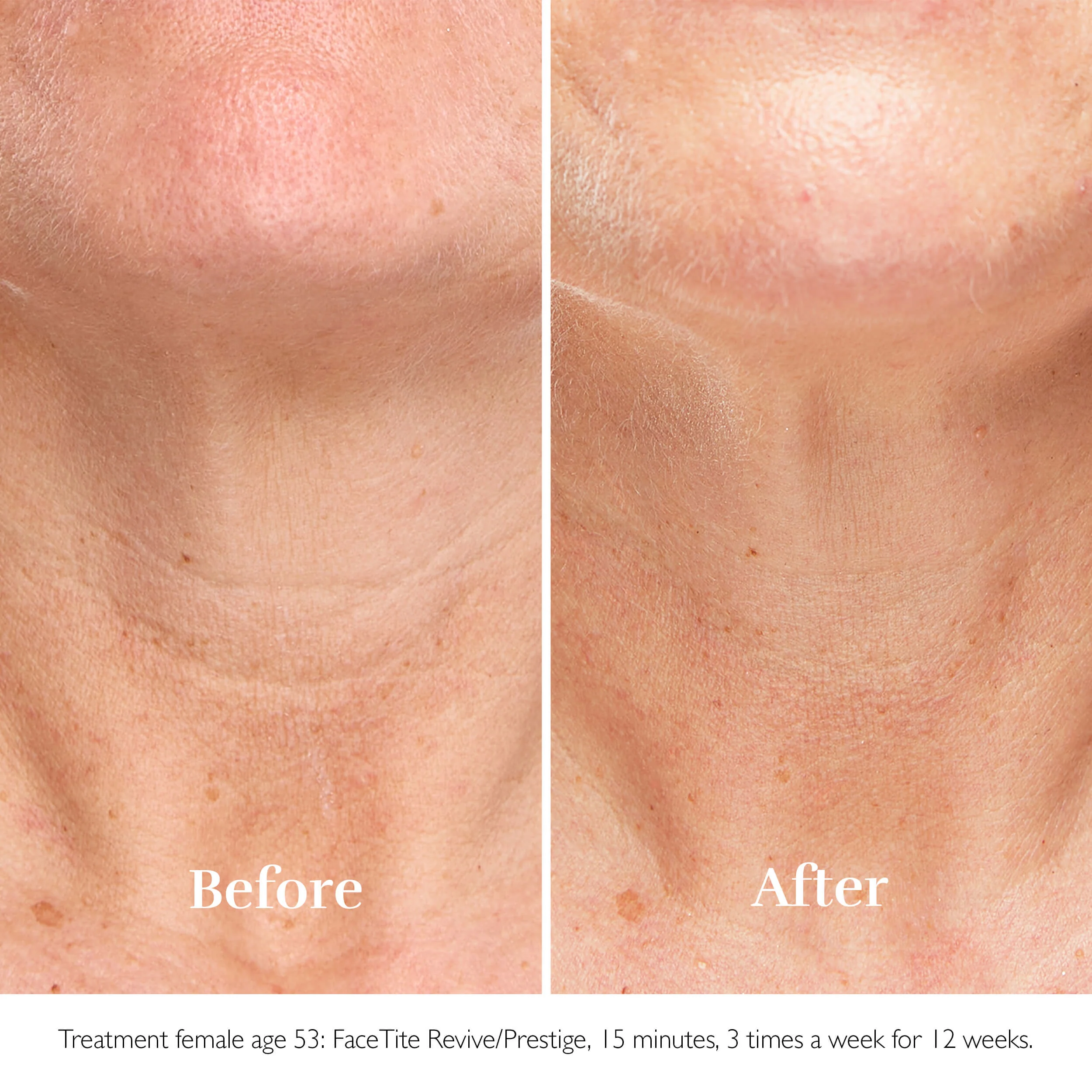 Silk´n FaceTite ESSENTIAL přístroj na vyhlazení a redukci vrásek
