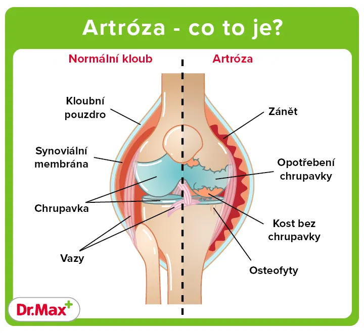 Porovnání zdravého kloubu a kloubu s artrózou