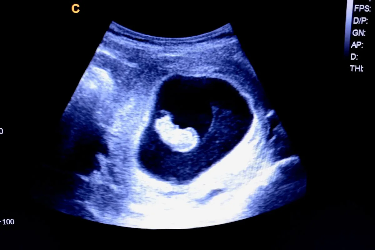 Ultrazvuk v 9. TT Ultrazvuk v 9. TT