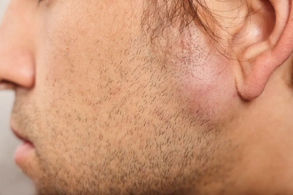 Lipomy – příznaky a léčba