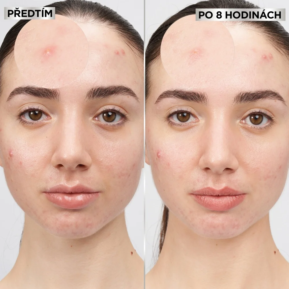 Garnier Pure Active Pimple Patch hydrokoloidní náplasti na nedokonalosti 8 ks