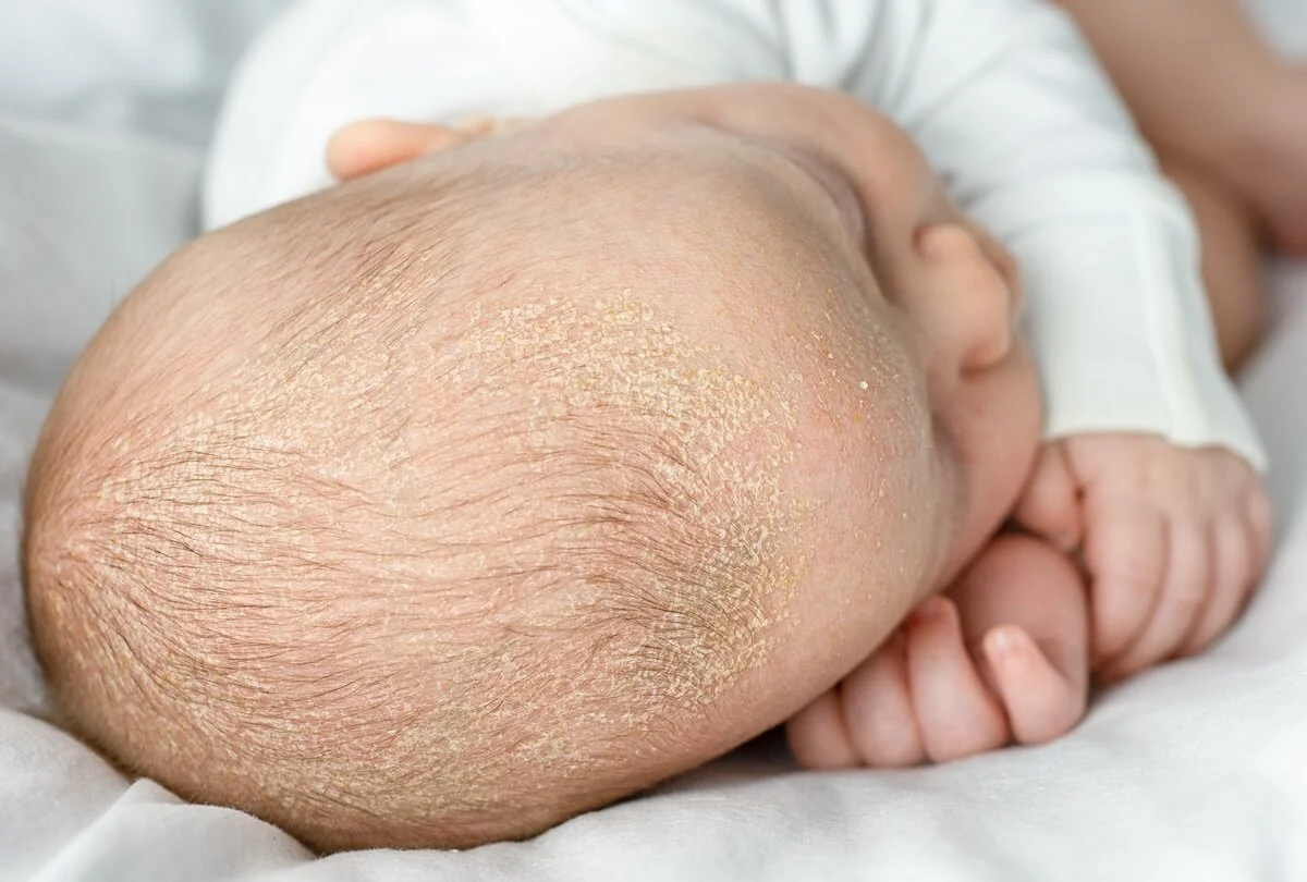 Seboroická dermatitida u novorozence Seboroická dermatitida u novorozence