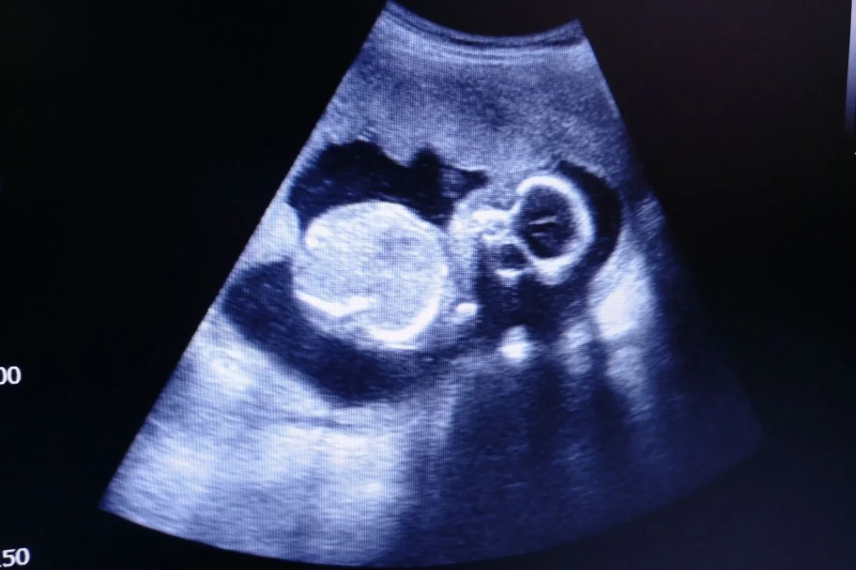 Ultrazvuk v 19. TT Ultrazvuk v 19. TT